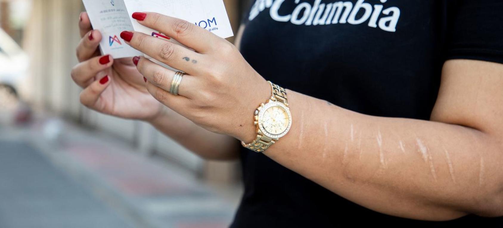 Las cicatrices en los brazos de Shiraz narran su historia de lucha.